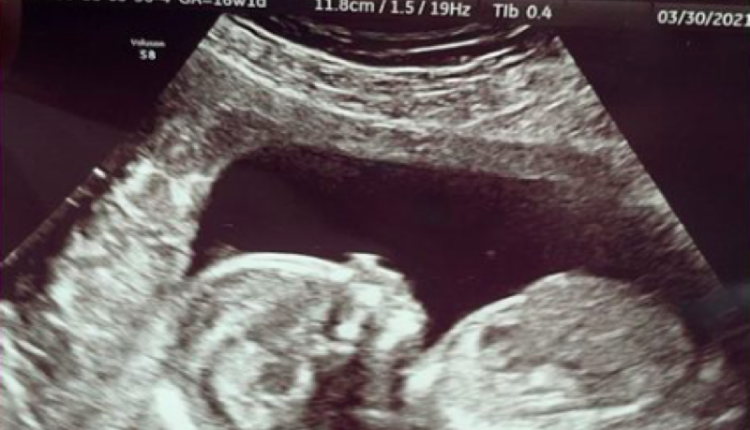 Unexpected-Lexus-baby-ultrasound