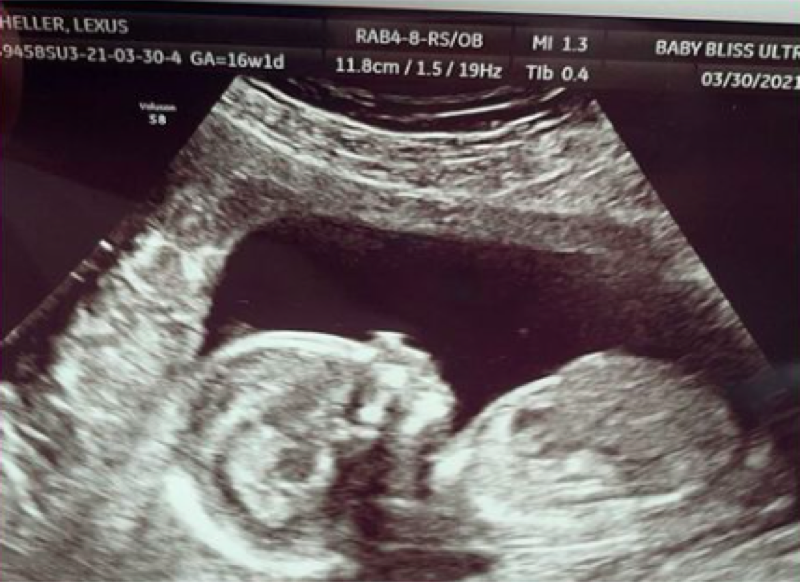 Unexpected: Lexus Scheller's baby ultrasound